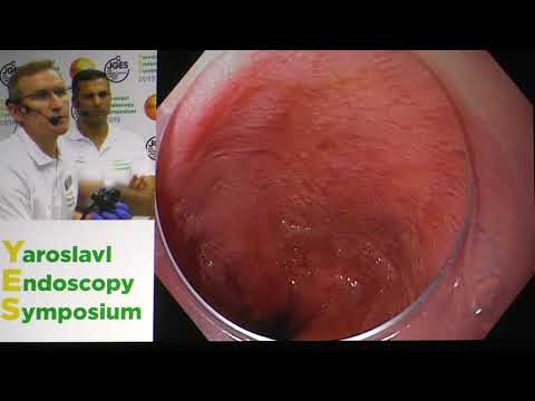 Видео: 20Live Пищевод Барретта С4М6 увеличительная эндоскопия