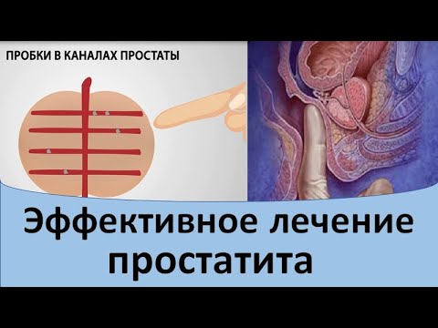 Видео: Эффективное лечение простатита