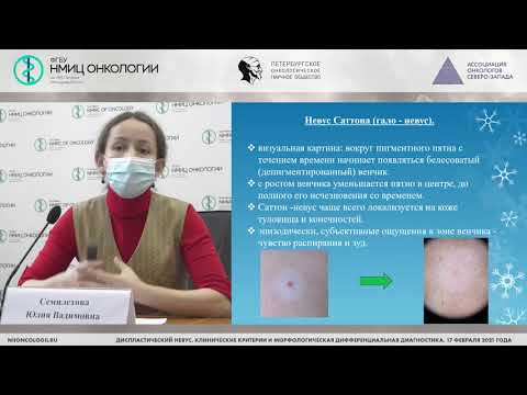 Видео: Клинические характеристики (критерии) и дифференциальная диагностика диспластического невуса