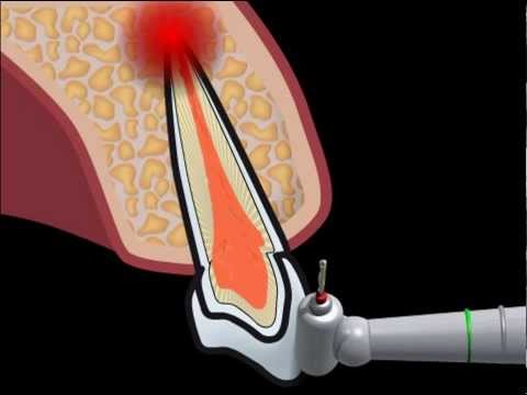 Видео: Резекция верхушки корня