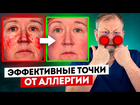 Видео: Возможно ли победить Аллергию? 4 приема скорой помощи при заложенности, отеке, высыпаниях. Аллергия