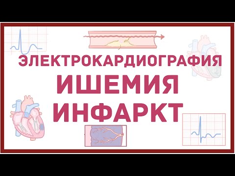 Видео: ЭКГ - инфаркт и ишемия