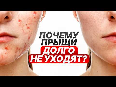 Видео: Единственный способ победить хронические прыщи! Это так просто, и он работает!