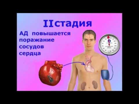 Видео: Артериальная гипертензия (часть 2)