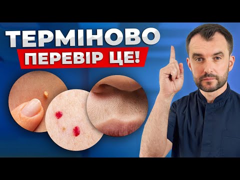 Видео: ТАК ПОЧИНАЄТЬСЯ ЦУКРОВИЙ ДІАБЕТ! Ранні симптоми, які ви не помічаєте!