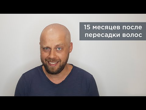 Видео: 15 Месяцев ПОСЛЕ ПЕРЕСАДКИ ВОЛОС методом FUE