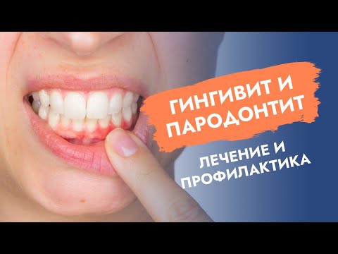 Видео: Гингивит и пародонтит. Лечение и профилактика.