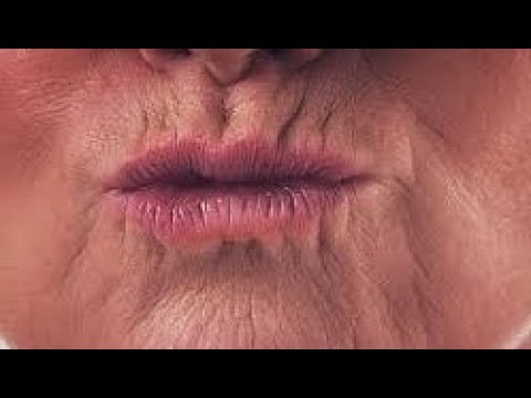 Видео: МОРЩИНЫ НА ВЕРХНЕЙ ГУБЕ. Кисетные морщины.