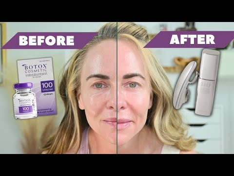 Видео: МИКРОТОКОВАЯ ТЕРАПИЯ ДЛЯ ЛИЦА | Разрушает ли микроток ботокс? | Обзор ZIIP Halo