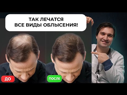 Видео: Как вылечить выпадение волос?