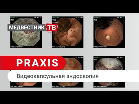 Видео: Praxis: Видеокапсульная эндоскопия