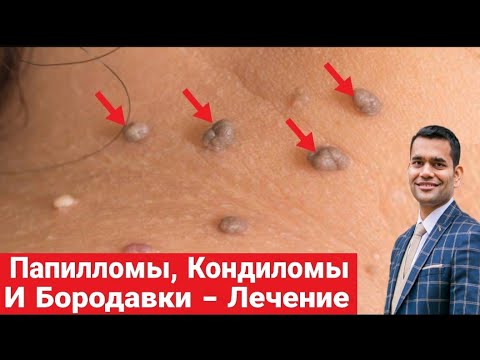Видео: Папилломы, Кондиломы И Бородавки. Внутренние Причины И Домашнее Лечение