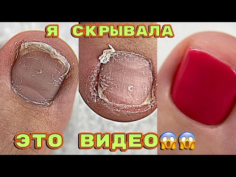 Видео: ВРОС НОГОТЬ 😱 Подногтевая мозоль / Педикюр на себе