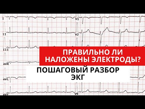 Видео: Разбор ЭКГ с неправильно наложенными электродами. Анализ ЭКГ.