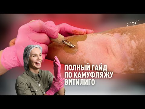 Видео: Как избавиться от витилиго. Белые пятна на коже. Решение проблемы.