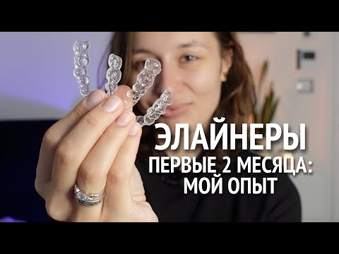 Видео: как я поставила ЭЛАЙНЕРЫ | подготовка, уход, стоимость и результат