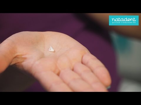 Видео: 19. Детские коронки на молочные зубы - плюсы и минусы. Натадент