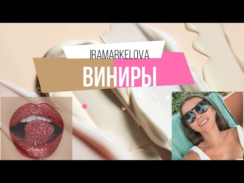 Видео: Виниры! Флюороз! Жизнь с винирами спустя 2,5 года! Шок фото!