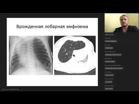 Видео: Хирургическое лечение ЖПР у детей - Степаненко Н.С.