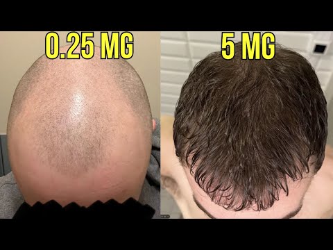 Видео: ЭТО ЛУЧШАЯ ДОЗИРОВКА МИНОКСИДИЛА ДЛЯ ПРИЕМА ПЕРОРАЛЬНО ОТ ВЫПАДЕНИЯ ВОЛОС!