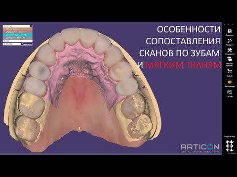 Видео: ОСОБЕННОСТИ СОВМЕЩЕНИЯ СКАНОВ В EXOCAD. Правильная тактика подгрузки waxup-скана и prep-скана