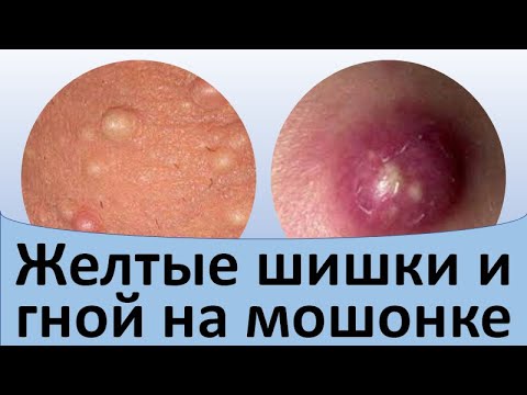 Видео: Желтые шишки и гной на мошонке