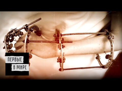 Видео: Аппарат Илизарова / Первые в мире