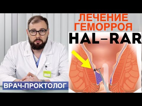 Видео: Лечение геморроя методом Hal-Rar - дезартеризация геморроидальных узлов. Лечение за 1 день