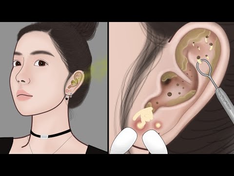 Видео: Удовлетворяющая терапия чистки ушей | ASMR анимация удаления прыщей, угрей | Meng's Stop Motion