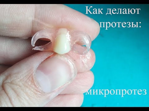 Видео: Стоматология - Как делают протезы :  микропротез на верхний премоляр ; immediate  denture