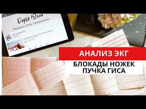 Видео: Блокада правой и левой ножек пучка Гиса. ЭКГ диагностика. Двухпучковая, трехпучковая блокады.