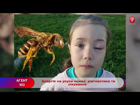 Видео: Алергія на укуси комах: діагностика та лікування