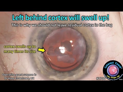 Видео: CataractCoach™ 2730: оставленная кора хрусталика опухнет!