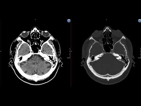 Видео: Укладка для КТ ГМ - компьютерной томографии головного мозга