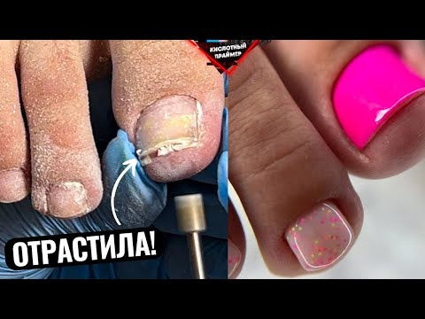 Видео: 2 МЕСЯЦА ПЕДИКЮРУ! ОЧЕНЬ ДЛИННЫЕ НОГТИ и СНОВА ПОДНОГТЕВАЯ МОЗОЛЬ😫