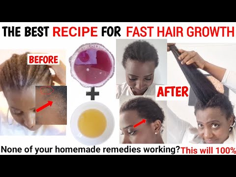 Видео: ЛУЧШИЙ РЕЦЕПТ ДЛЯ БЫСТРОГО РОСТА ВОЛОС | ОТРАСТИТЕ ВОЛОСЫ БЫСТРО | НАТУРАЛЬНЫЕ ВОЛОСЫ 4C | ЛУКОВЫ...