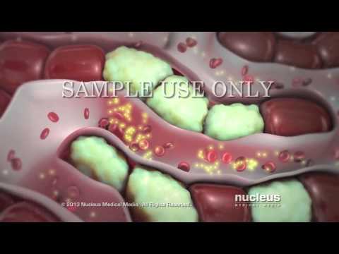 Видео: Гепатиты А и В