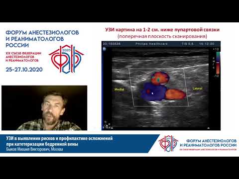 Видео: УЗИ при катетризации бедренной вены Быков М.В.