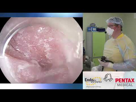 Видео: Пероральная миотомия при ахалазии кардии. К. В. Шишин