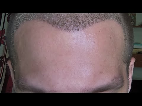 Видео: 7 ДНЕЙ после пересадки волос. Какие ощущения? Как проходит восстановление?