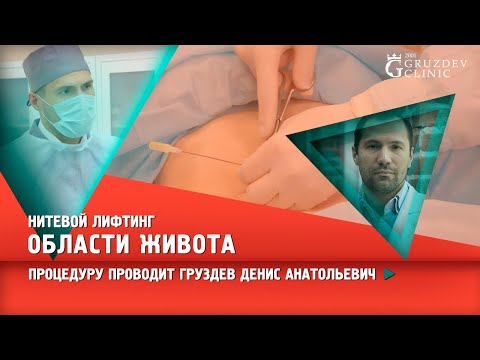 Видео: Нитевой лифтинг области живота