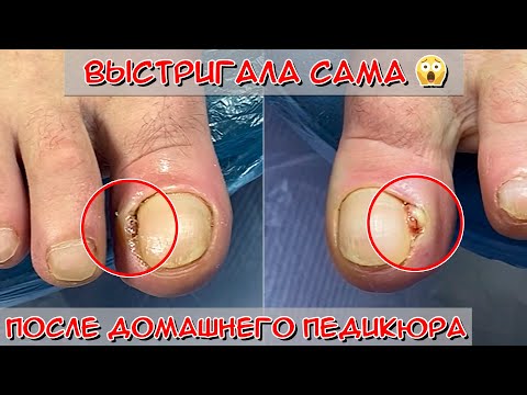 Видео: Педикюр в домашних условиях / Врос ноготь после домашнего педикюра