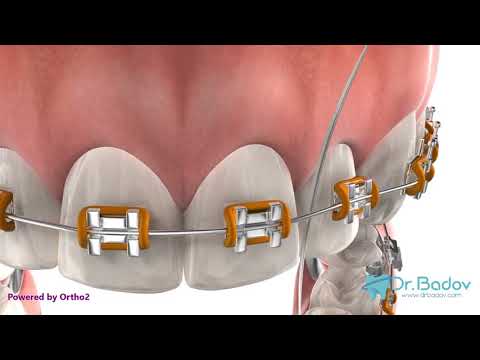 Видео: #миененазъбисбрекети #брекети Как да си мием зъбите ако носим брекети?