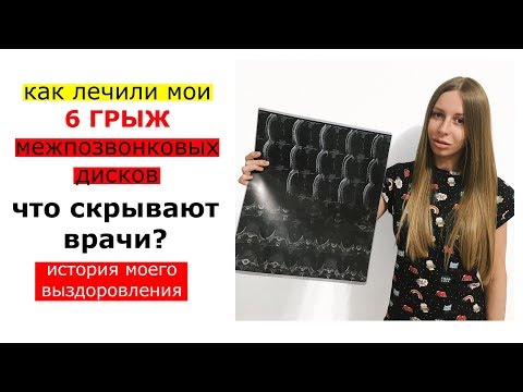 Видео: Грыжа диска. Как лечили мои 6 грыж в позвоночнике. История моего выздоровления.