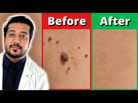 Видео: Как избавиться от папиллом быстрее | 3 простых шага по удалению папиллом
