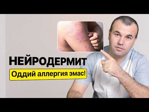 Видео: Тери касалликлари ичида энг хавфлиларидан — Нейродермит ҳақида билиб олинг