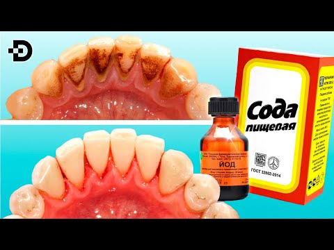 Видео: ТИШЛАРНИ ТОШДАН ТОЗАЛАШ САРҒАЙГАН ТИШЛАР ОППОҚ БЎЛАДИ УЙ ШАРОИТИДА