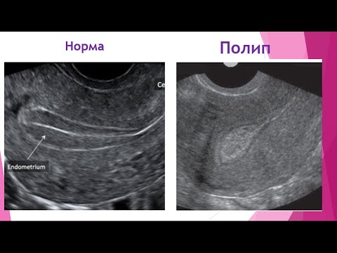 Видео: Эндометрий: физиология ва патология