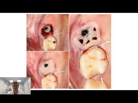 Видео: Индивидуальные заживляющие абатменты 14. 04. 21.