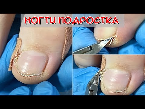Видео: Уход за ногтями / ПОДРОСТКОВЫЕ НОГТИ на ногах